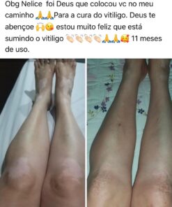 Protocolo para auxiliar no tratamento de vitiligo com 5 produtos