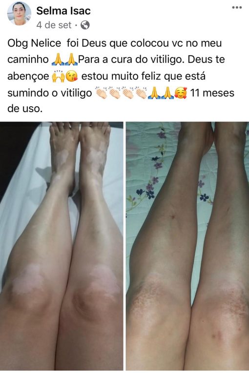 KIT PARA VITILIGO
