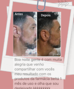 Protocolo PARA 4 MESES com 6 produtos para cuidados diários para auxiliar na pele com  vitiligo