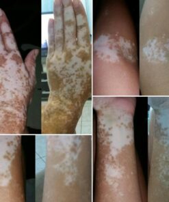 Protocolo para auxiliar no tratamento de VITILIGO PARA  4 MESES COM 13 FRASCOS DE PRODUTOS