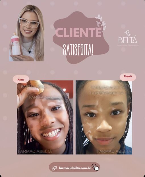 Protocolo   Infantil para vitiligo